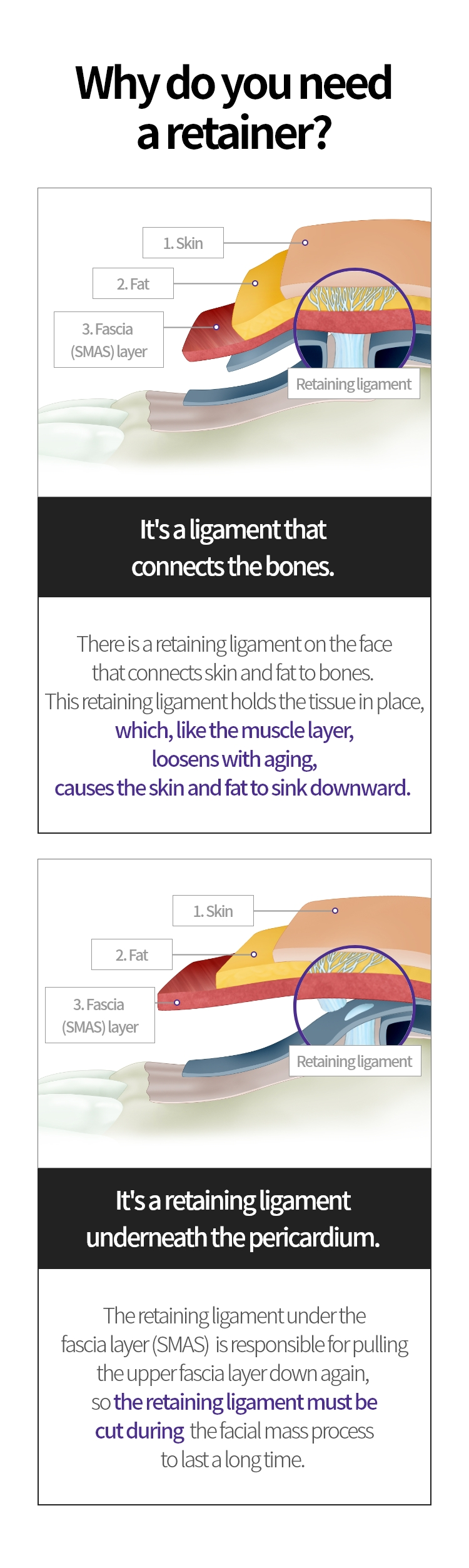 
			유지인대 박리가 필요한 이유:

			뼈와 이어주는 유지인대-
			얼굴에는 피부 및 지방을 뼈와 이어주는
			유지인대가 있습니다. 이 유지인대는
			여러 조직들이 제 위치에 있을 수 있도록
			잡아주는 역할을 하는데 유지인대
			역시 근육층과 마찬가지로 노화에 따라
			느슨해지게 되며 그에 따라 피부 및 지방들이
			아래로 처지게 됩니다.

			근막층 아래에 있는 유지인대-
			근막(SMAS)층 아래에 있는 유지인대는
			위로 당긴 근막(SMAS)층을 다시 아래쪽으로
			끌어내리는 역할을 하기 때문에 안면거상
			진행 시 유지인대를 끊어줘야
			효과가 오래갈 수 있습니다.
			