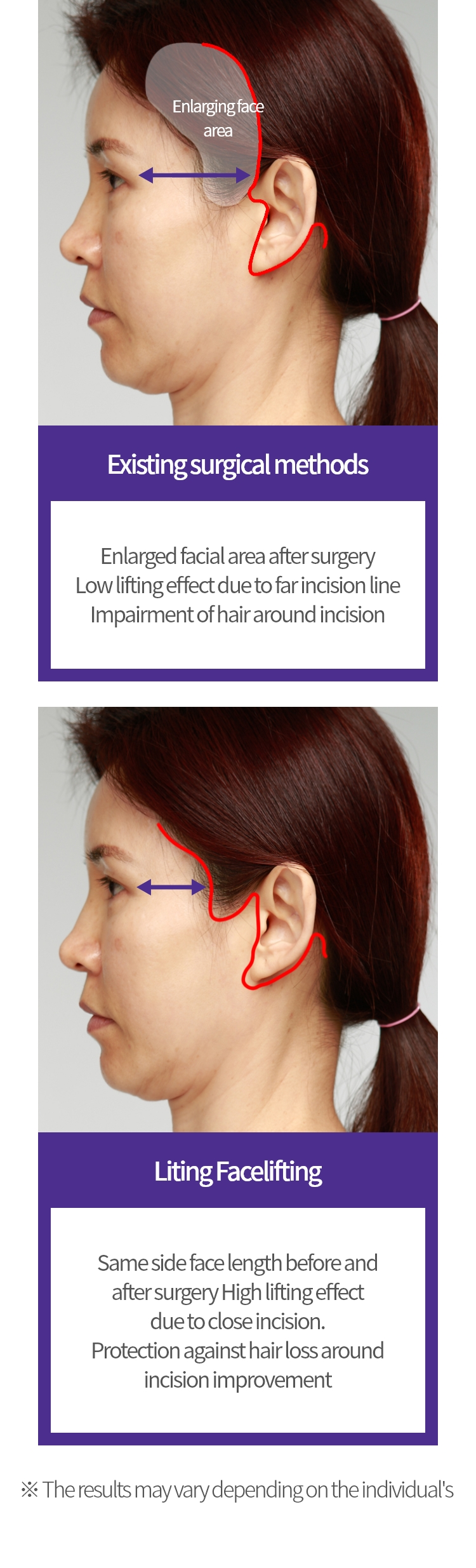 기존 수술방법 :
			수술 후 넓어진 얼굴 면적
			절개선이 멀어 낮은 리프팅 효과
			절개선 주위 모근 손상

			리팅 안면거상:
			수술 전/후 옆 얼굴 길이 동일
			절개선이 가까워  높은 리프팅 효과
			절개선 주위 모근 손상 방지
			