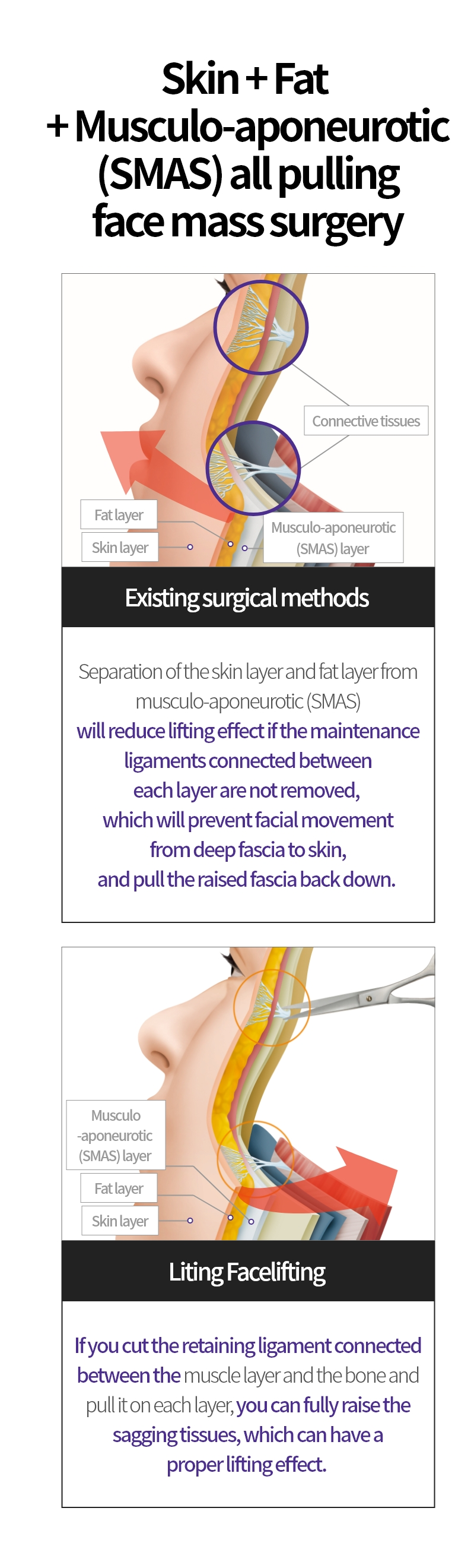 
			피부+지방+근막(SMAS)층모두 당기는리팅 안면거상 수술법:

			기존 수술방법
			피부층, 지방층을 근막(SMAS)층과
			분리해도 각 층사이 연결된 유지인대를
			제거하지 않으면 깊은 근막에서
			피부까지 단단하게 고정되어 얼굴
			움직임을 방해하고, 위로 올린
			근막층을 다시 아래로 당기는 역할을
			하기 때문에 리프팅 효과가 떨어지게 됩니다.

			리팅 안면거상
			근육층과 뼈 사이에 연결된 유지인대를
			끊은 후 각 층별로 당기면 처진 조직들을
			충분히 끌어올릴 수 있어 제대로 된
			리프팅 효과를 볼 수 있습니다.
			