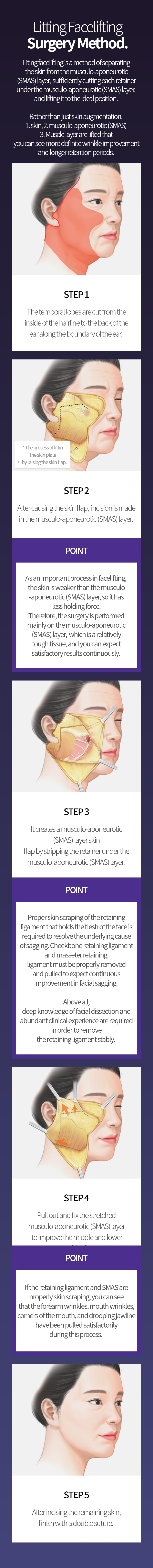 
			리팅 안면거상 수술방법
			리팅 안면거상은 피부와 근막(SMAS)층을
			분리하고 근막(SMAS)층 아래의 각 유지인대를
			충분하게 끊어준 후 이상적인 위치로 끌어올려
			리프팅 하는 방법입니다.

			단순 피부만 거상하는 방법이 아닌,
			1.피부 2.근막(SMAS) 3.근육층을
			끌어올려 보다 확실한 주름개선 효과와
			오랜 유지 기간을 확인할 수 있습니다.
			