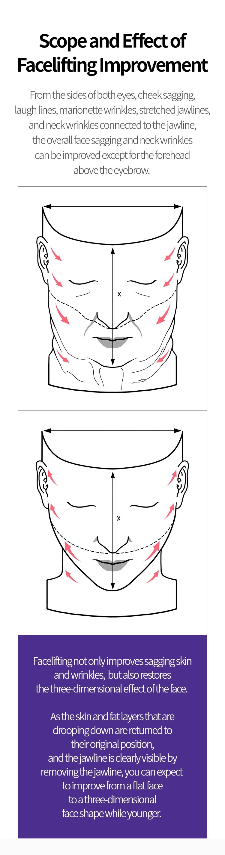 
			안면거상 개선범위와 효과
			양 눈가 옆, 볼 처짐, 팔자 주름, 심술보,
			마리오네트 주름, 늘어진 턱 선
			턱 선과 연결되는 목주름까지 눈썹 위의
			이마를 제외한 얼굴 전반적인 처짐과
			목주름까지 개선을 할 수 있습니다.

			안면거상술은 처진 피부와 주름 개선 뿐만
			아니라 얼굴의 입체감을 회복시켜주는
			효과가 있습니다.

			아래로 처진 피부와 지방층을 원래의
			자리로 되돌려주고, 군턱을 제거하여
			턱선이 선명하게 드러나기 때문에
			편평한 얼굴에서 입체적인 얼굴형으로
			회복되면서 보다 젊은 동안 이미지로의
			개선을 기대할 수 있습니다.

			