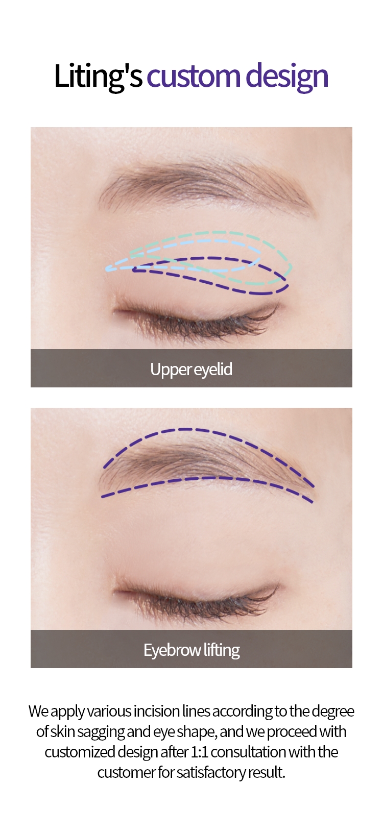리팅 만의 맞춤 디자인 : 상안검 / 눈썹거상 / 피부 처짐 정도와 눈 모양에 따라 절개 라인이 다앙하여, 만족스러운 결과를 위해 고객님과 1:1 상담 후 맞춤 디자인을 진행합니다. 