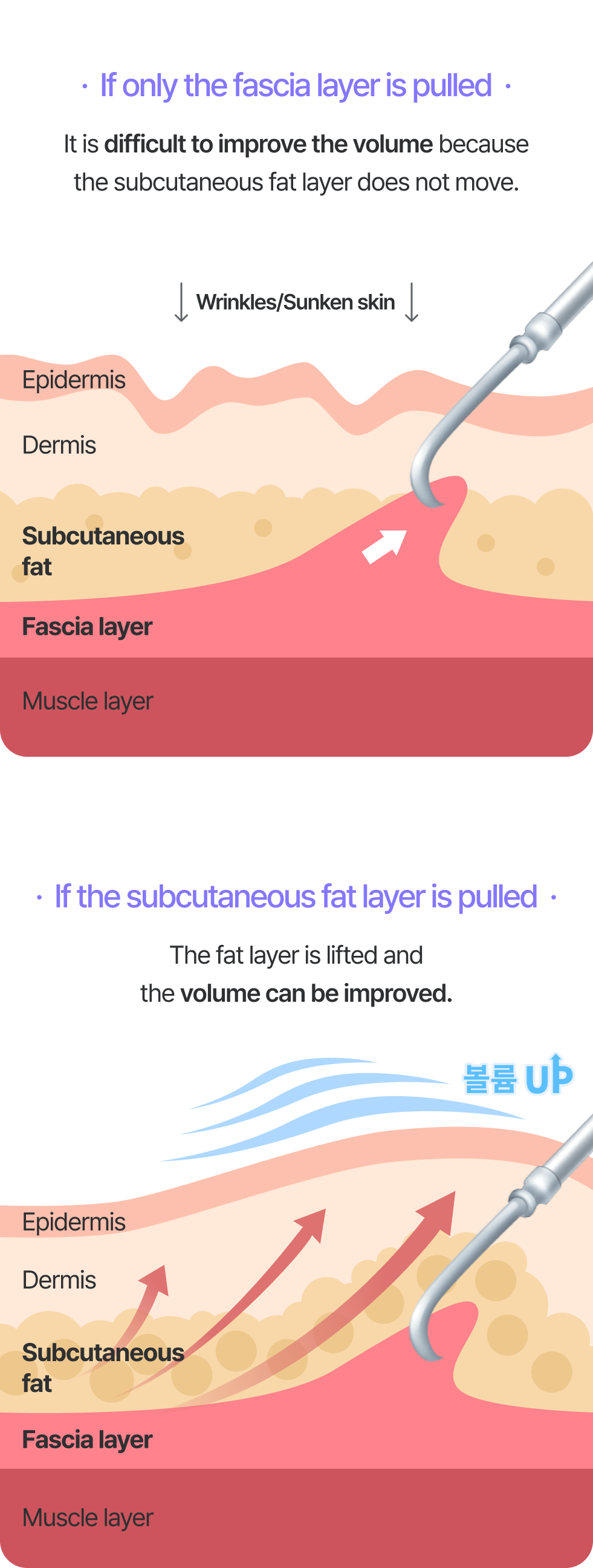 筋膜層だけ引っ張る場合:皮下脂肪層が移動しないため、ボリューム感の改善が困難 シワ/へこんだ肌 / 筋膜層まで引っ張る場合:脂肪層がリフトアップされ、ボリューム改善が可能