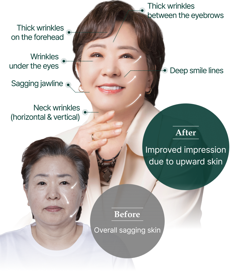 Before: Skin generally sagging down, After: Improved impression with uplifted skin