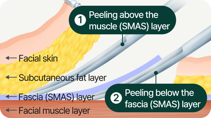 1. Dissection above the Fascia (SMAS) Layer, 2. Dissection below the Fascia (SMAS) Layer