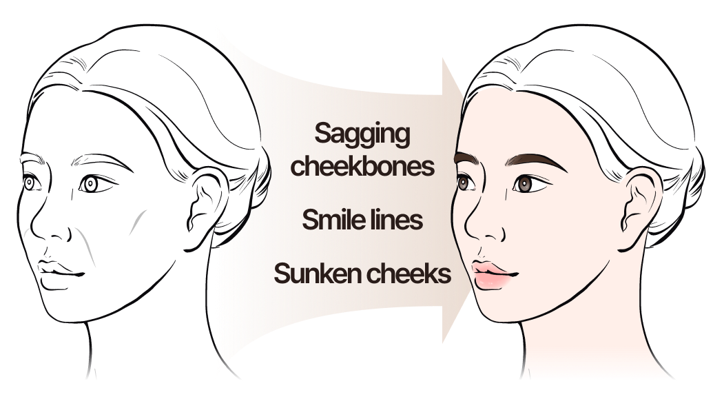 Sagging cheekbone lines, nasolabial folds, sunken cheeks