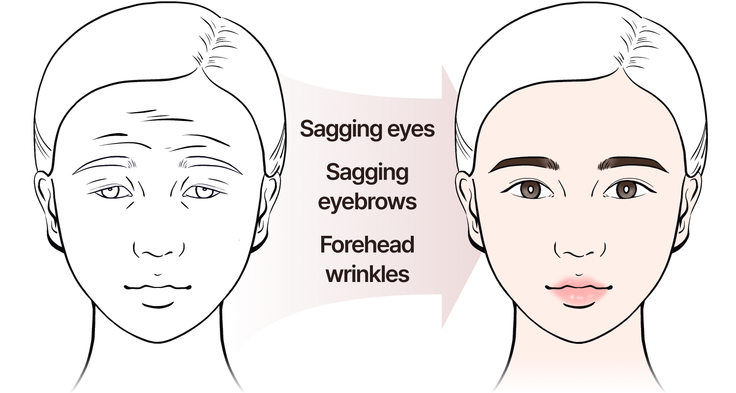 Sagging eyes, sagging eyebrows, forehead wrinkles