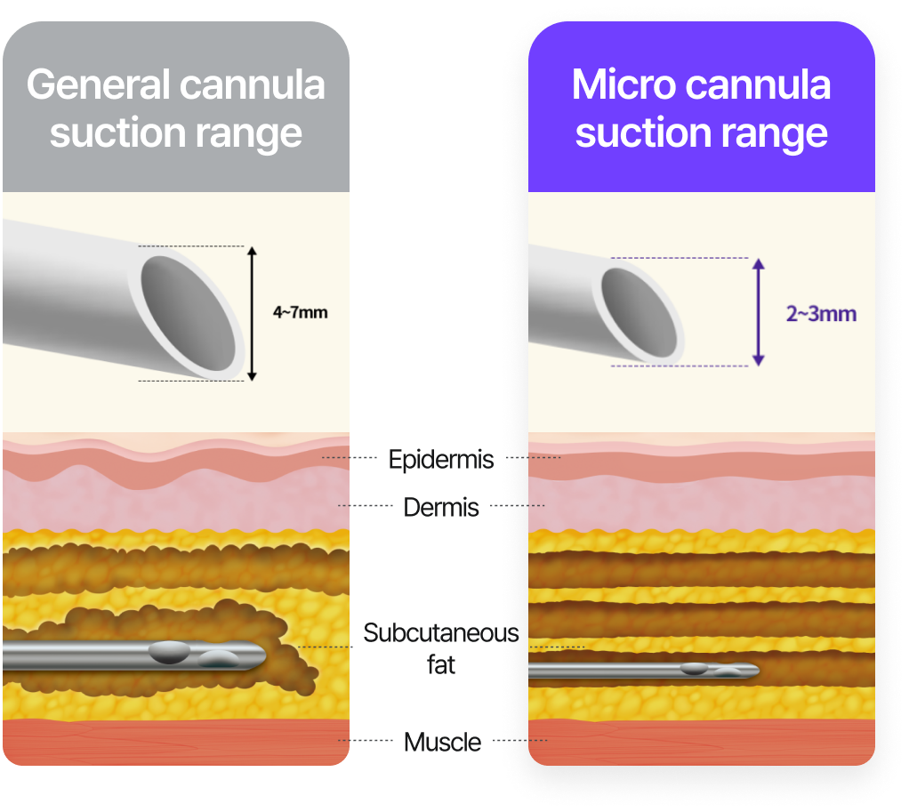 General cannula suction range: 4~7mm / Micro cannula suction range: 2~3mm (less damage to subcutaneous fat)