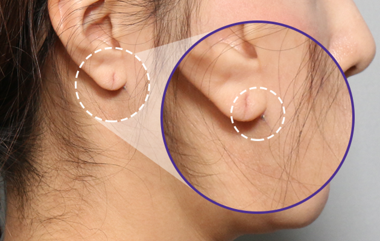 Incision behind the earlobe