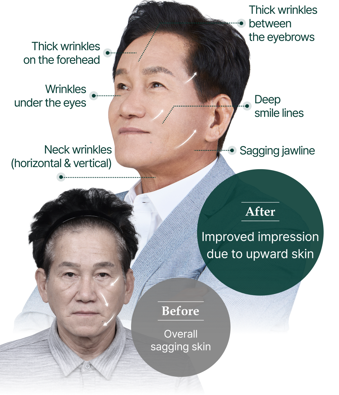 Before: Skin generally sagging down, After: Improved impression with uplifted skin