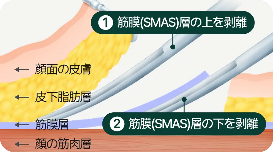 1. Dissection above the Fascia (SMAS) Layer, 2. Dissection below the Fascia (SMAS) Layer