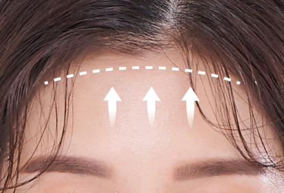 Forehead Lifting Surgery