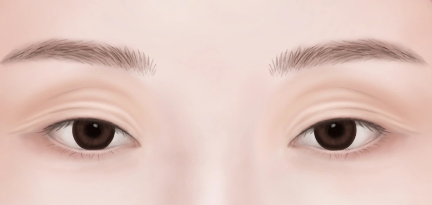 Sagging eyelids